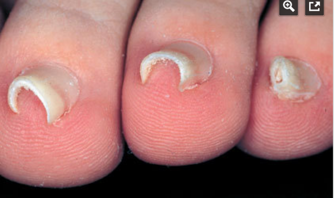 <p>what nail disorder is this?</p>