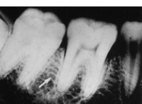 <p>Cancellous Bone</p>