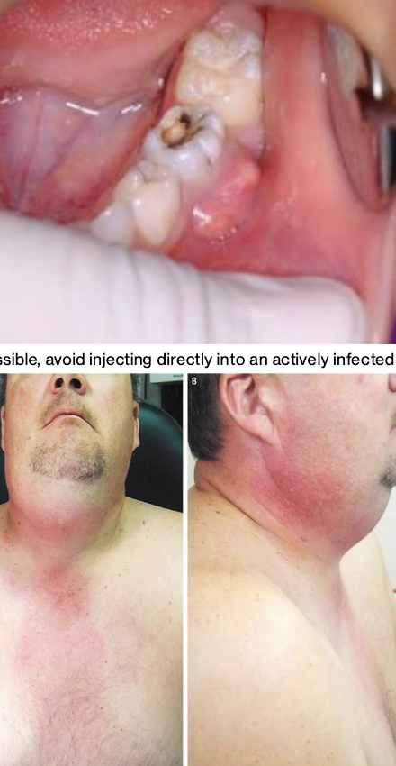 <p><strong>Complication</strong> – Your pt has an active infection and/or a painful symptomatic tooth and you need to anesthetize them in order to provide tx</p>