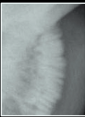 <p>How would you describe this periosteal reaction pattern?</p>