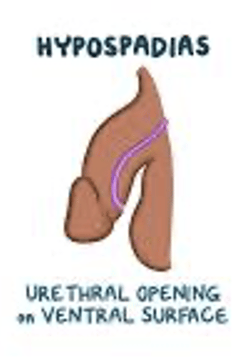 <p>urethra opens onto the ventral surface instead of at the tip; MC congenital anomaly of the penis</p>
