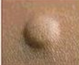<p>What is the type of lesion and how is it defined?</p>
