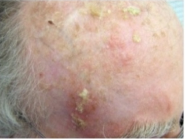 <p><span>Patient in the following picture. What drug to administer?</span></p><p><span>Actinic keratosis: Premalignant lesions caused by sun exposure.Small, rough, erythematous or brownish papules or plaques, Risk of squamous cell carcinoma is proportional to degree of epithelial dysplasia</span></p>