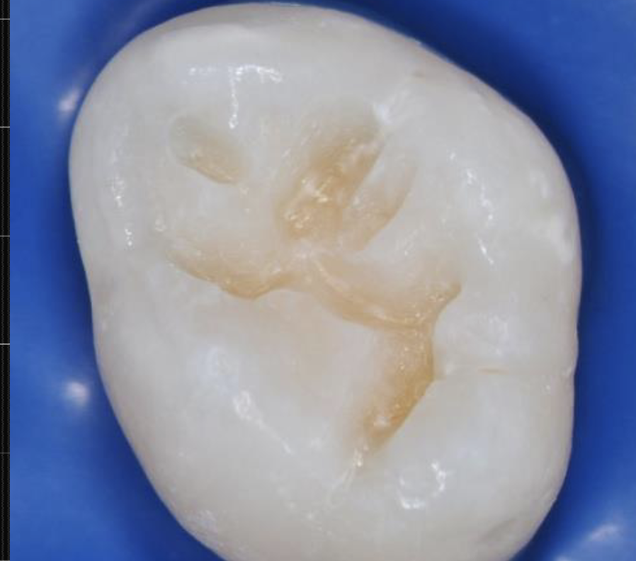 <p>Hard Dentin</p>