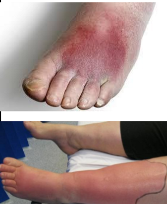 <p>What kind of lesion is this?</p>