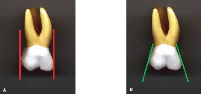 <p><span style="color: rgb(255, 0, 0);"><strong>A: Incorrect </strong></span></p><ul><li><p>Red lines — incorrect alignment to distal and mesial surfaces of maxillary molar</p></li></ul><p></p><p><span style="color: green;"><strong>B: Correct</strong></span></p><ul><li><p>Green lines — Correct alignment to distal and mesial surfaces of maxillary molar</p></li></ul><p></p>
