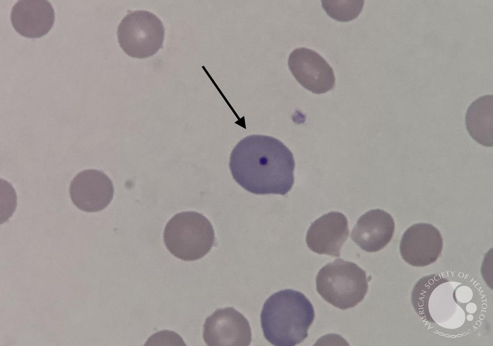 <p>Splenectomy; thalassemia; hemolytic anemia; megaloblastic anemia; functional hyposplenia.</p>