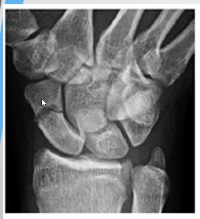 <ul><li><p><span>Accounts for more than 60% # of the wrist</span></p></li><li><p><span>3 locations</span></p><ul><li><p><span>Distal pole</span></p></li><li><p><span>Waist</span></p></li><li><p><span>Proximal pole</span></p></li></ul></li><li><p><span>Major blood supply through distal pole</span></p></li></ul><p></p>
