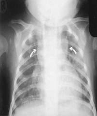 <p>- The thymus fails to develop so T cells don't mature and aren't functional</p>