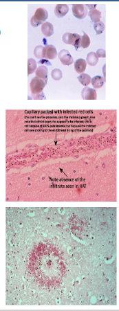<p>Malaria - Plasmodium falciparum</p>