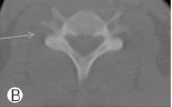 <ol><li><p>small body </p></li><li><p>large vertebral foramina</p></li><li><p>transverse foramina</p></li><li><p>bifid (split into two) spinous process</p></li></ol><p></p>