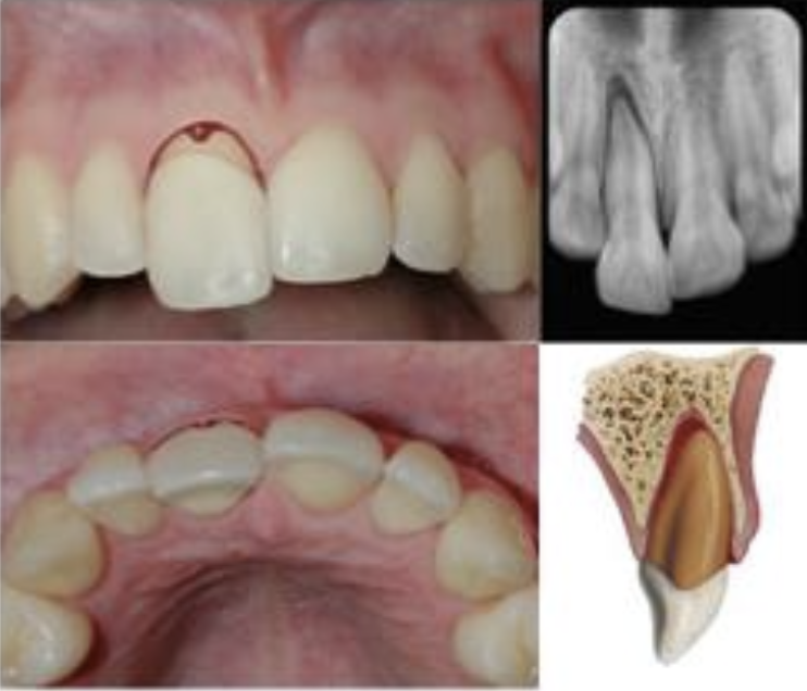 <p>Which of the following injuries is shown in the figure?</p><p>A. Extrusion </p><p>B. Avulsion </p><p>C. Subluxation </p><p>D. Lateral luxation </p>
