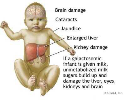 <p><span>·</span><span style="font-family: "Times New Roman"; line-height: normal; font-size: 7pt;"> </span><span><strong>Tay-Sachs disease (TSD) </strong>is a disorder of lipid metabolism that is inherited in an autosomal recessive pattern.</span></p><p class="MsoListParagraphCxSpMiddle"><span>·</span><span style="font-family: "Times New Roman"; line-height: normal; font-size: 7pt;"> </span><span>It occurs most frequently in individuals of Jewish descent from eastern Europe (the Ashkenazi Jewish population).</span></p><p class="MsoListParagraphCxSpMiddle"><span>·</span><span style="font-family: "Times New Roman"; line-height: normal; font-size: 7pt;"> </span><span>This is a lethal recessive condition as the missing enzyme results in the accumulation of a fatty substance in the nervous system.</span></p><p class="MsoListParagraphCxSpMiddle"><span>·</span><span style="font-family: "Times New Roman"; line-height: normal; font-size: 7pt;"> </span><span>A baby with two recessive alleles for TSD develops normally for the first few months, and then deterioration causing mental and physical disabilities begins.</span></p><p class="MsoListParagraphCxSpLast"><span>·</span><span style="font-family: "Times New Roman"; line-height: normal; font-size: 7pt;"> </span><span>Death usually occurs in early childhood.</span></p><p class="MsoListParagraphCxSpLast"></p>