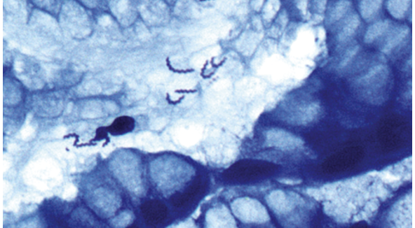 <p>Ulcères gastriques. </p><p>1) Diagnostic</p><p>2) risque lymphome et carcinome par rapport àH.Pylori</p><p></p>