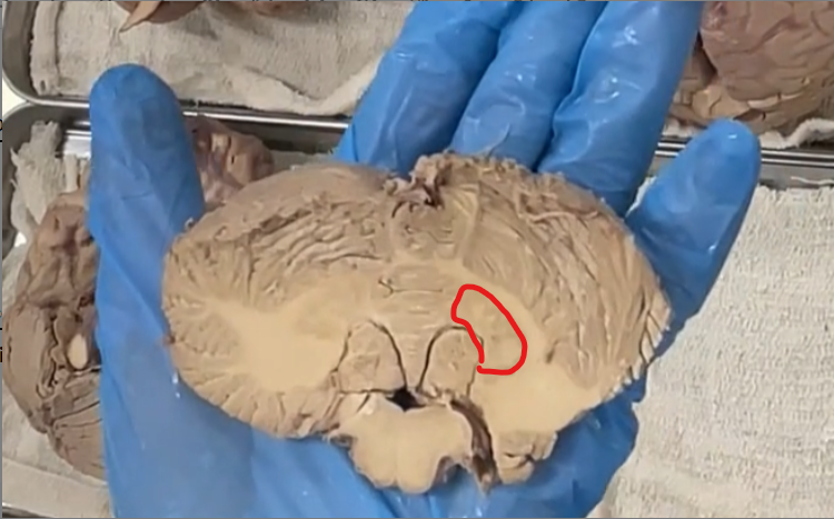 <p>the only cerebellar nucleus we are able to see with the naked eye is the dentate nucleus. </p>