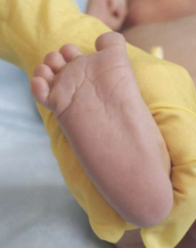 <p>few creases seen across the entire foot </p>