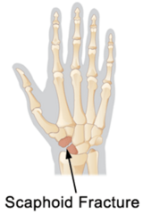 <p>pain/edema/ecchymosis at Anatomical Snuff Box </p><p>OR</p><p>pain with Axial Loading of Thumb</p>