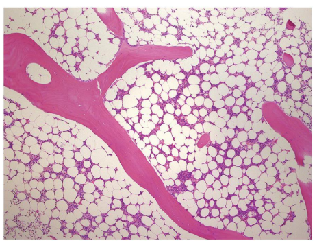 <p>fatty marrow stores adipose</p><p>replaces most red bone marrow in adults</p><p>not hematopoietic, but can revert back to red bone marrow</p>