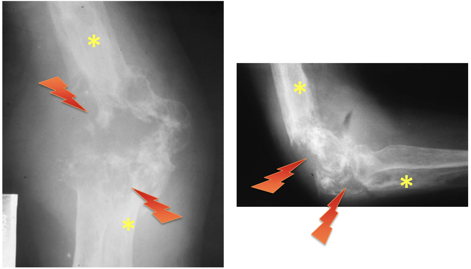 <p>What tumour like disorder is this?</p>