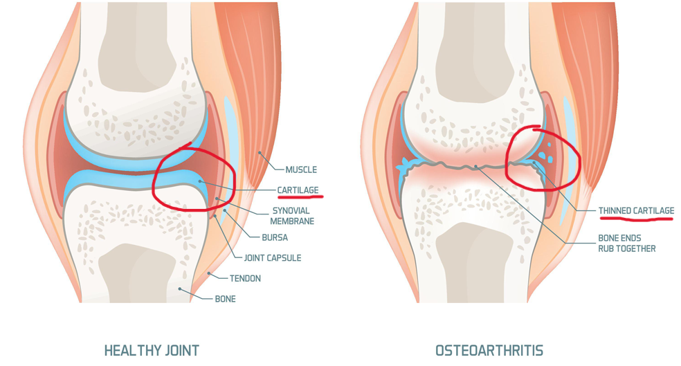 <p><span style="background-color: rgba(0, 0, 0, 0);"><strong>Osteoarthritis</strong></span></p>