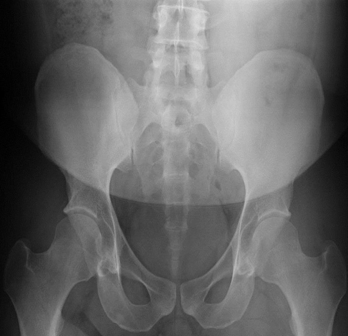 <p>Anterior Posterior Lumbo-Pelvic Landmarks</p>