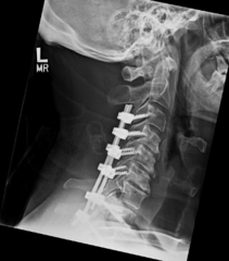 <p>- more morbid than anterior, usually requiring decompression of cord</p><p>- adjacent segments fused</p>