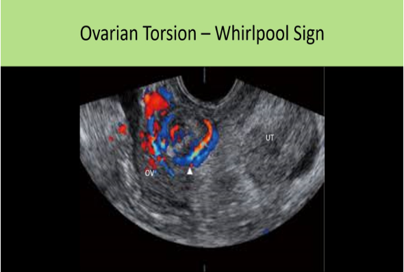 <p>B. ovarian torsion</p><p>The torsion of the vascular pedicle may appear as an ill-defined adnexal mass adjacent to the ovary. In cross section, the adjacent mass can have a target appearance = "whirlpool" sign</p>