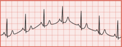 <p>The recording has wavelike up-and-down movements throughout the tracing</p>
