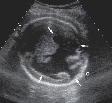 <p>Fluid-filled clefts within the cerebrum</p><p>Agenesis of the CSP and corpus callosum (50% of the time)</p><p>Ventriculomegaly</p>