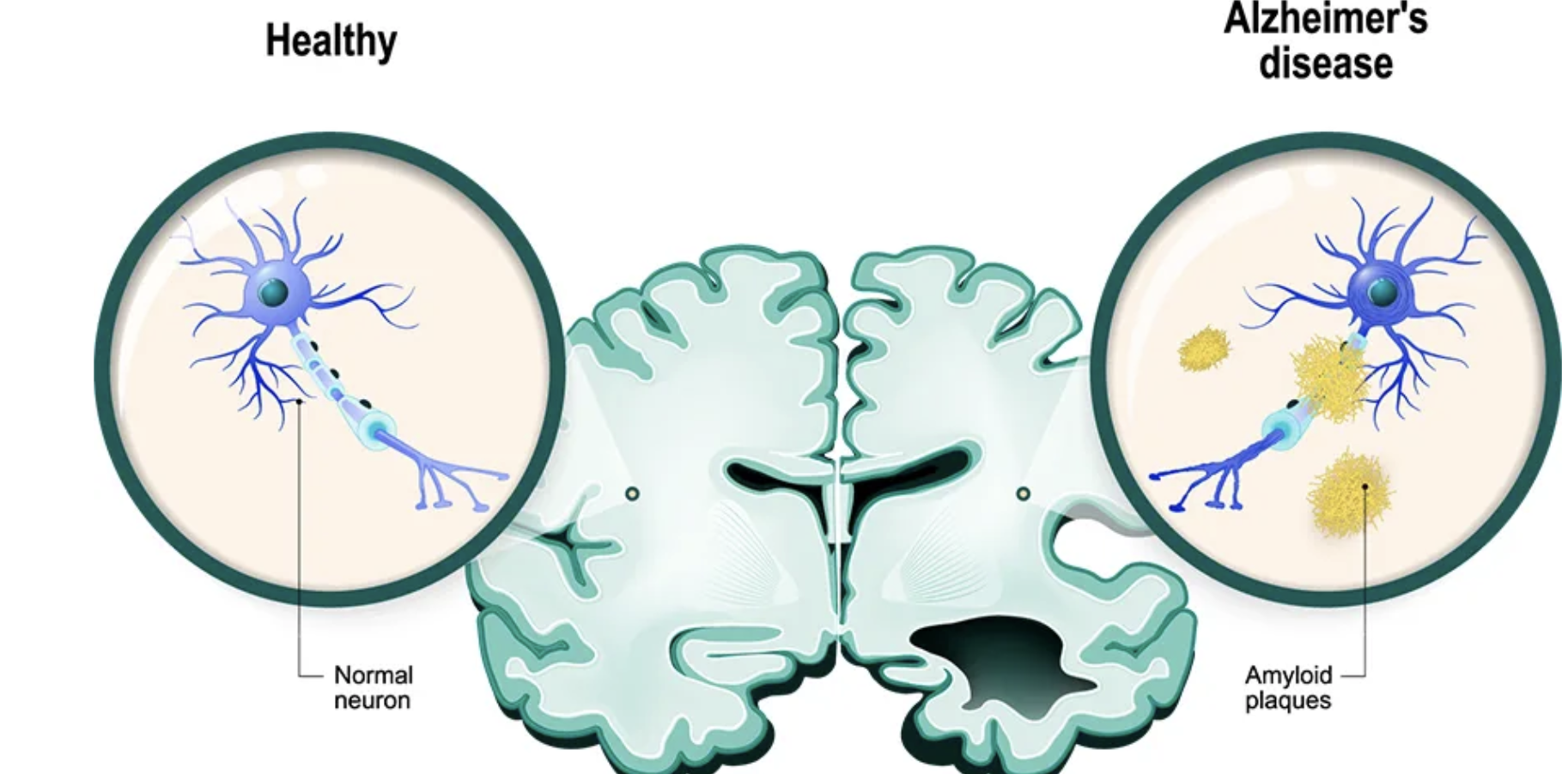 <p><span style="color: red;">C. Thoái hóa neuron cholinergic tại nhân nền</span></p><p><span style="background-color: transparent;"><strong>Bệnh Alzheimer</strong>: bệnh thiếu acetylcholine, sự tích tụ mảng β-amyloid tăng hoạt tính <strong>AcHE</strong> (Acetylcholine-<strong>esterase</strong>) hơn </span><span data-name="arrow_right" data-type="emoji">➡</span><span style="background-color: transparent;">Phân huỷ ACh nhanh hơn</span></p><p><span style="background-color: transparent;"><strong>Donepezil</strong>: thuốc điều trị Alzheimer, bằng cách ức chế enzyme ChAT để duy trì ACh</span></p>