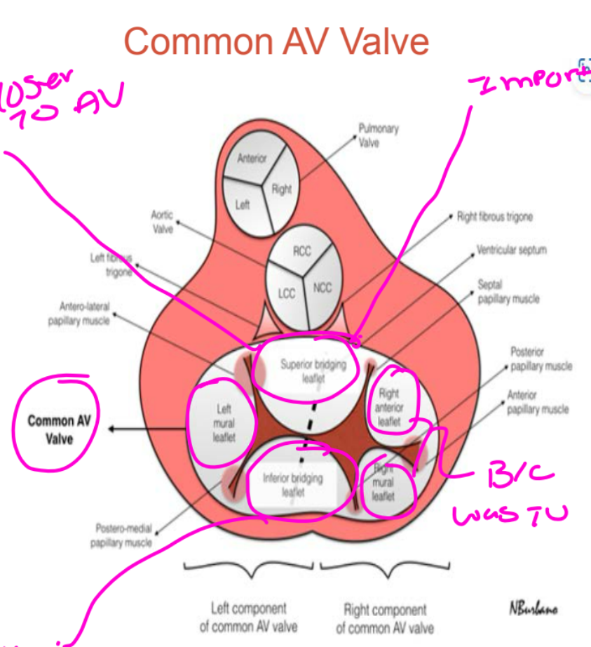 <ul><li><p>The <strong>superior bridging leaflet</strong> corresponds to the anterior mitral leaflet.</p></li><li><p>The <strong>inferior bridging leaflet</strong> represents fusion of the septal tricuspid leaflet with the inferior part of the anterior mitral leaflet.</p></li><li><p>TV has 3 leaflets and MV 2 leafelts = 5 leafelts</p></li></ul><p></p>