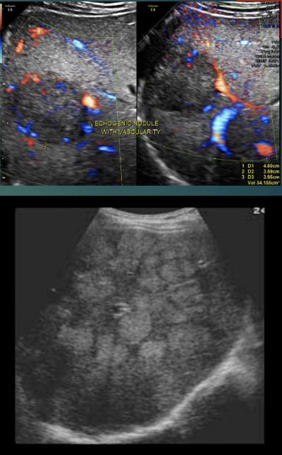 <p>liver tumors incidence: 8 to 20 times more common than HCC, liver disease are: Gallbladder, colon, stomach, pancreas, kidney, ovaries, breast, and lung.</p><p>Increased vascularity</p>