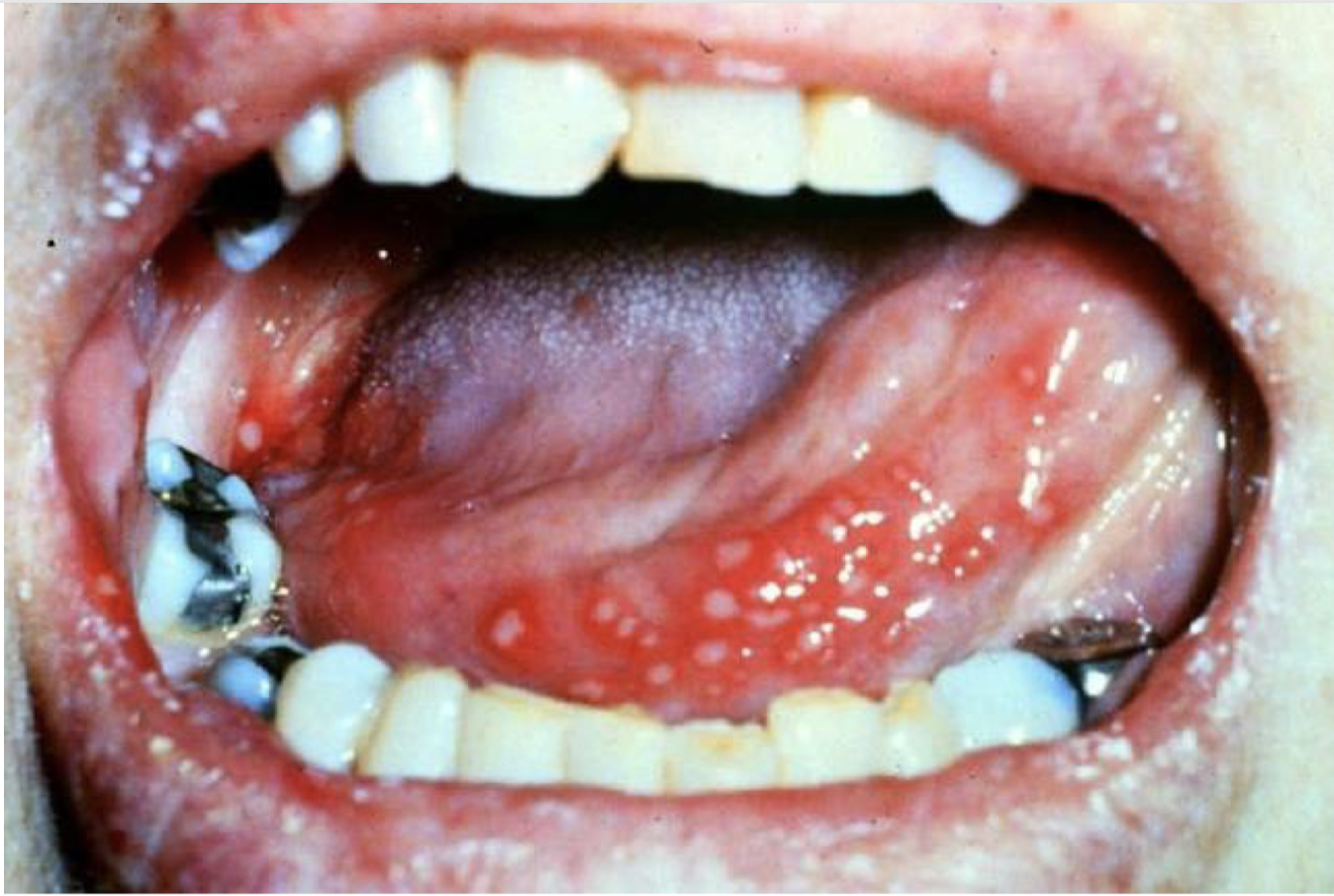 <p>what are these lesions associated with</p>