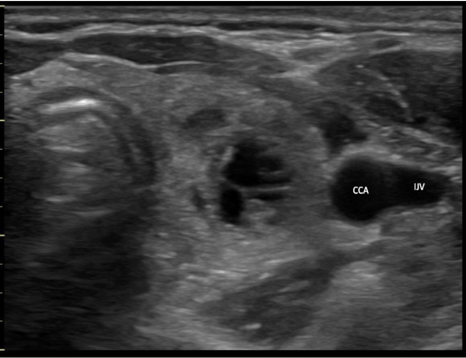<p>C. right common carotid artery</p><p>The right common carotid artery is located lateral to the right lobe of the thyroid and demonstrates an anechoic circular shape in a transverse view of the mid thyroid.</p><p>The image displays the left lobe of the thyroid with the circular CCA immediately lateral to the mid lobe and ovoid IJV lateral to the CCA.</p>