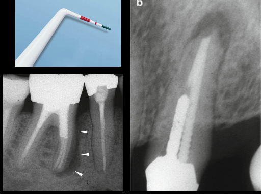 <ul><li><p>PA: halo or J-shaped PARL </p></li><li><p>CBCT </p></li></ul><p></p>