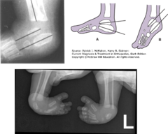 <p>X-ray</p><p>Loss of the normal angle between talus and calcaneus, results in parallel relationship</p><p>U/S can detect in utero</p>