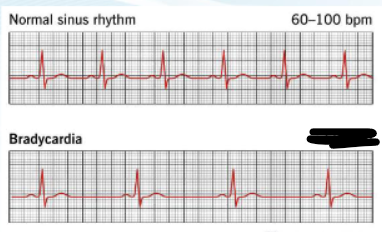 <p><strong><u>BRADYCARDIA</u></strong></p><ol><li><p>HR ____ bpm</p></li><li><p>s/s (unstable) → 5</p></li><li><p>Treatment →</p></li><li><p>MOA →</p></li><li><p>^max cumulative dose of _____</p></li><li><p>^INEFFECTIVE in _____ and ______</p></li><li><p>If unresponsive → 3</p></li></ol><p></p>