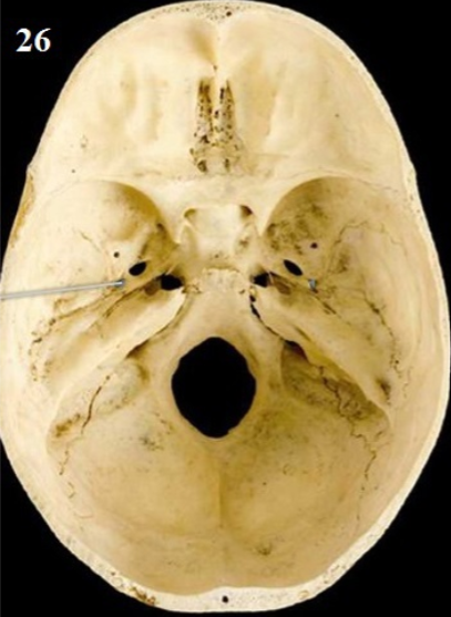 <p>Name this Foramen and What Runs Through It</p>