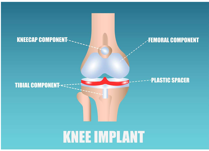 <p>kneecap component, femoral component, tibial component, plastic spacer</p>