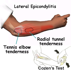 <p>LATERAL EPICONDYLITIS AKA TENNIS ELBOW</p><p>you can do a COZEN TEST</p>