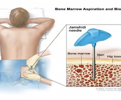 <p><span>bone marrow</span><br><span>-used for anemic and pancytopenia (shortage of all 3 major cells)</span><br><span>-aspirated in posterior superior iliac crest for biopsy. must sign consent form, physician gives.</span><br><span>-sharp brief pain in procedure. lidocaine is used, direct pressure after. patient can lay on that side.</span></p>