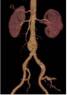 <p>67-letni moški, aktivni kadilec, hipertonik, s hiperholesterolemijo </p><p>Znana PAB, opravljena uspešna PTA leve arterije femoralis superficialis </p><p>UZ abdomna: AAA premera 3,4 cm</p>