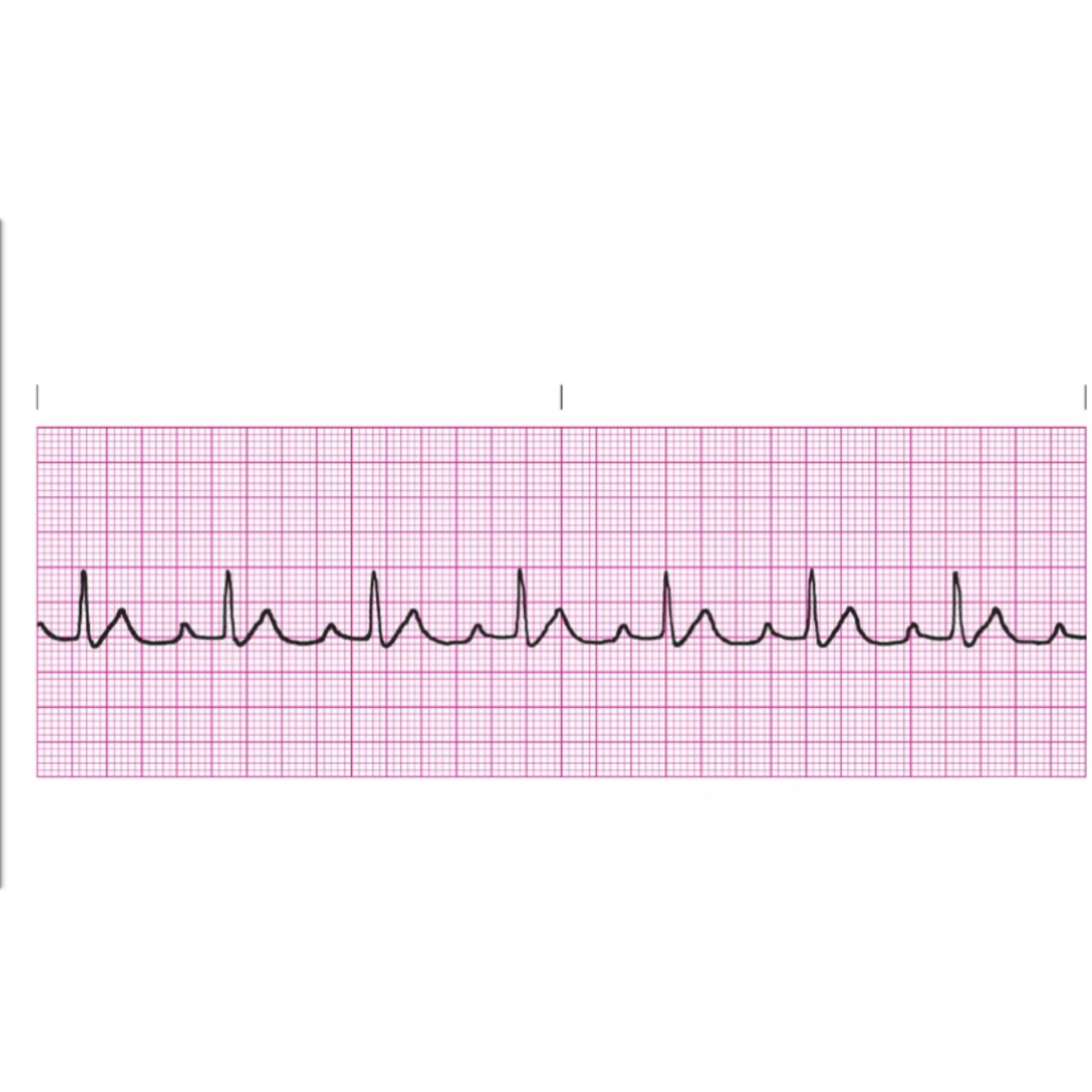 <p>Rules for First Degree Heart Block</p>