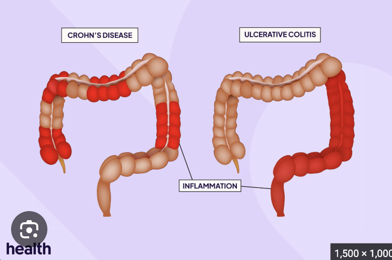 <p>Chronic inflammatory condition</p><p>May involve any portion of the GI tract</p><p>Charactered by transmural inflammation of the bowel</p><p>Most commonly affects ileum and proximal colon</p><p>Lesions are not always continuous (skip lesions)</p><p>Etiology</p><ul><li><p>Not completely understood</p></li><li><p>Appears to involve environmental factors, microbial imbalance in gut, genetic susceptibility and inappropriate immune response</p></li></ul><p>Pathogenesis </p><ul><li><p>Inflammation and destruction of the bowel </p></li></ul><p>Manifestations </p><ul><li><p>Nausea, vomiting, and diarrhea with or w/o blood </p></li><li><p>Abdominal pain and pain with defecation due to anorectal fissures </p></li><li><p>Complications include bowel strictures (abnormal narrowing of the small or large intestine that slows or blocks the passage of waste), obstructions, perforations (holes) in bowel and intra-abdominal abscesses (collection of infected fluid and pus surrounded by inflamed tissue or organs)</p></li></ul><p></p>