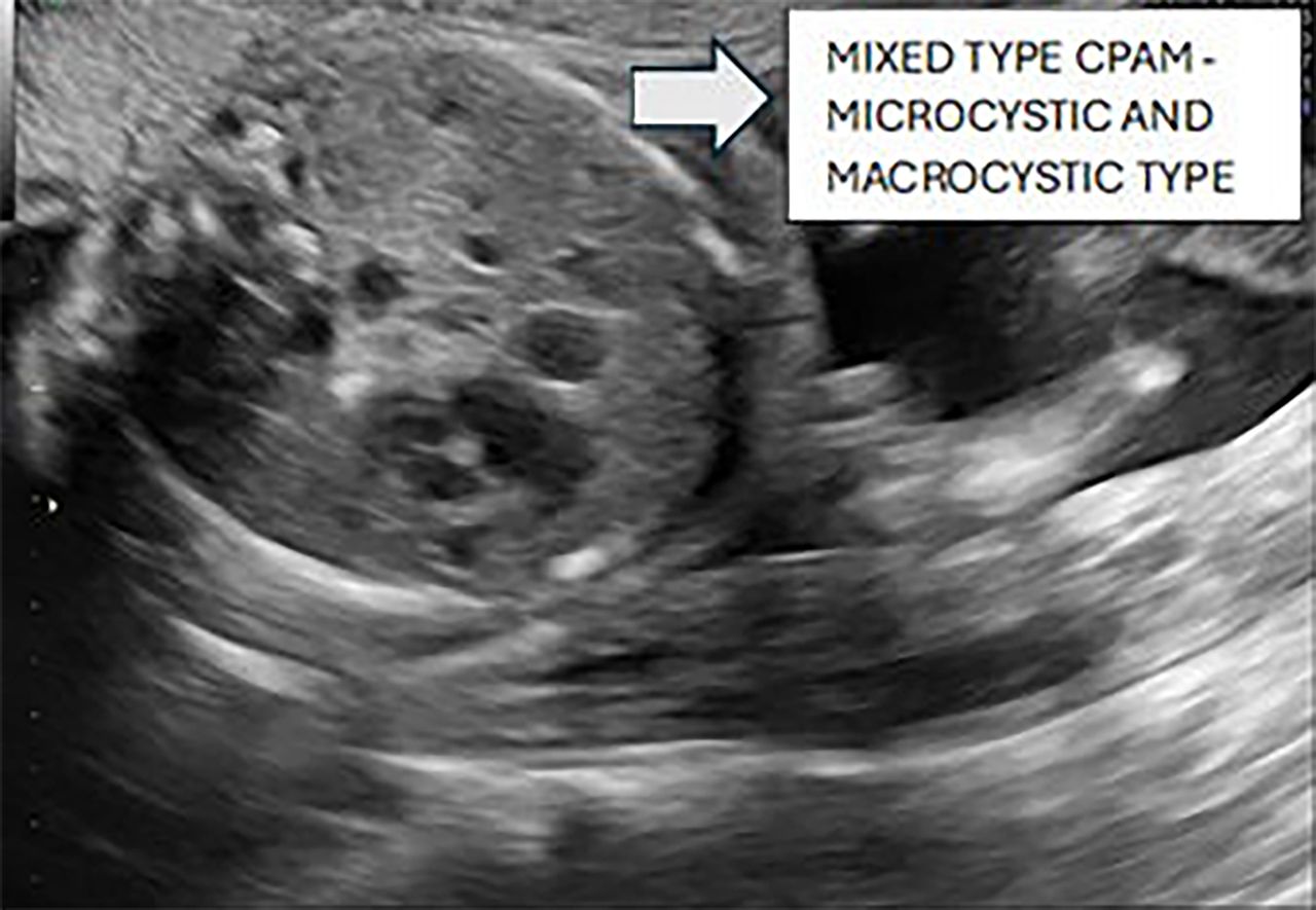 <p>a mix of cystic and solid appearance   </p><p>micro/macro mix</p>