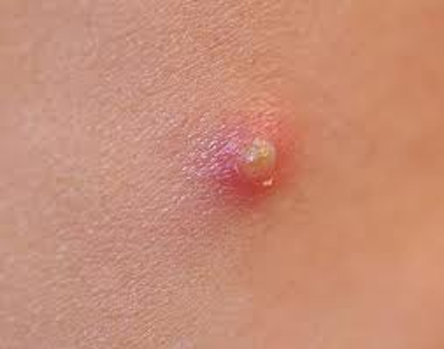 <p>comedones, Also known as a whitehead, a follicle is impacted with dead cells and solidified sebum, appearing as a small white bump just under the skin's surface. </p>