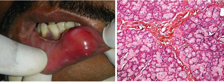 <p>adenomatoid hyperplasia</p>