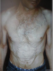 <p>A patient presents with dilation of periumbilical veins (caput medusa). Which vein is most likely involved in this condition?</p>