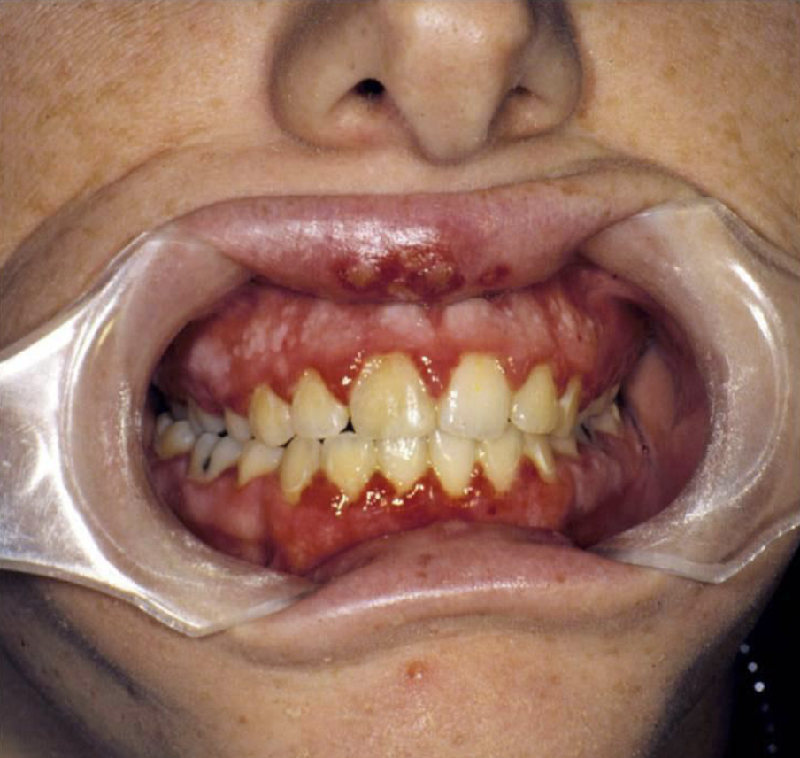 <p>yes - acute onset of malaise, fever, and lymphadenopathy</p>