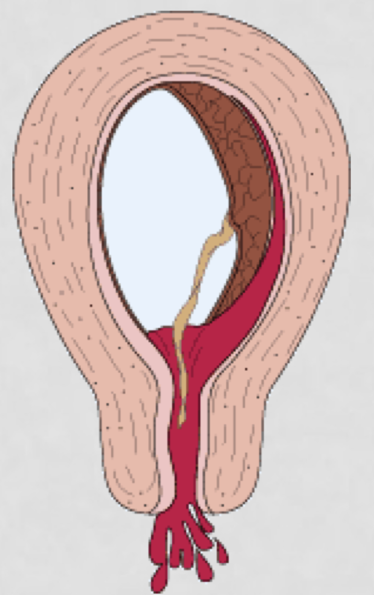 <ul><li><p>Moderate to heavy bleeding with passage of tissue</p></li><li><p>Severe cramping</p></li><li><p>Dilated cervix with tissue in os</p></li></ul><p></p>